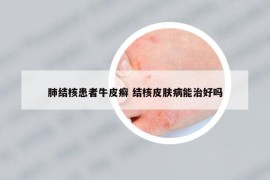 肺結(jié)核患者牛皮癬 結(jié)核皮膚病能治好嗎