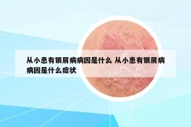 從小患有銀屑病病因是什么 從小患有銀屑病病因是什么癥狀
