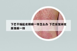 下巴干燥起皮跟癬一樣怎么辦 下巴反復(fù)掉皮屑像癬一樣