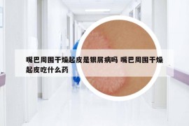 嘴巴周圍干燥起皮是銀屑病嗎 嘴巴周圍干燥起皮吃什么藥
