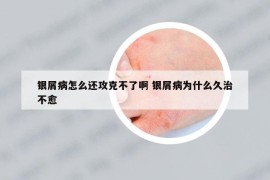 銀屑病怎么還攻克不了啊 銀屑病為什么久治不愈