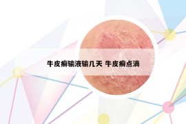 牛皮癬輸液輸幾天 牛皮癬點(diǎn)滴