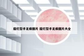 糜爛型手足癬圖片 糜爛型手足癬圖片大全