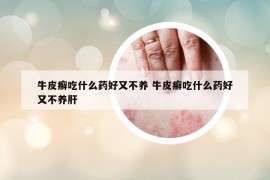牛皮癬吃什么藥好又不養(yǎng) 牛皮癬吃什么藥好又不養(yǎng)肝