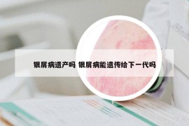 銀屑病遺產(chǎn)嗎 銀屑病能遺傳給下一代嗎