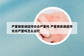 嚴(yán)重銀屑病遺傳也會(huì)嚴(yán)重嗎 嚴(yán)重銀屑病遺傳也會(huì)嚴(yán)重嗎怎么治療