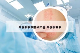牛皮癬發(fā)病特別嚴(yán)重 牛皮癬暴發(fā)