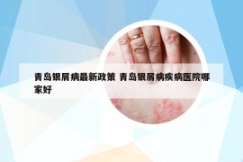 青島銀屑病最新政策 青島銀屑病疾病醫(yī)院哪家好