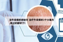 治牛皮癬的絕秘方 治療牛皮癬的3個(gè)小偏方,用過的都好了!