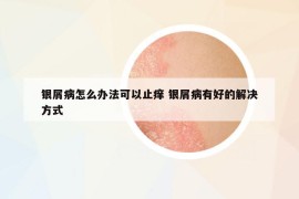 銀屑病怎么辦法可以止癢 銀屑病有好的解決方式