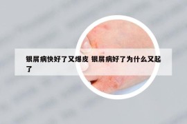 銀屑病快好了又爆皮 銀屑病好了為什么又起了