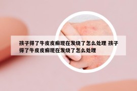 孩子得了牛皮皮癬現(xiàn)在發(fā)燒了怎么處理 孩子得了牛皮皮癬現(xiàn)在發(fā)燒了怎么處理