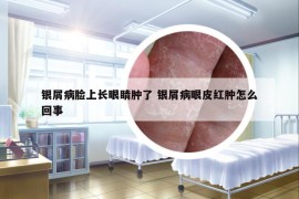 銀屑病臉上長眼睛腫了 銀屑病眼皮紅腫怎么回事