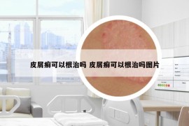 皮屑癬可以根治嗎 皮屑癬可以根治嗎圖片