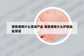 銀屑病用什么保濕產(chǎn)品 銀屑病用什么護(hù)膚品能保濕