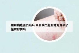 銀屑病瘡面凹陷嗎 銀屑病凸起的地方變平了是有好轉(zhuǎn)嗎