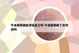 牛皮癬抓破能傳染自己嗎 牛皮膚癬破了會傳染嗎