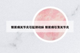 銀屑病關(guān)節(jié)炎引起頸動脈 銀屑病引發(fā)關(guān)節(jié)炎