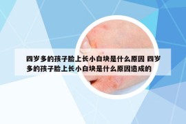 四歲多的孩子臉上長小白塊是什么原因 四歲多的孩子臉上長小白塊是什么原因造成的