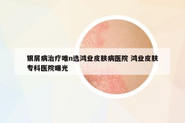 銀屑病治療唯n選鴻業(yè)皮膚病醫(yī)院 鴻業(yè)皮膚?？漆t(yī)院曝光