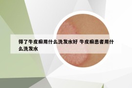 得了牛皮癬用什么洗發(fā)水好 牛皮癬患者用什么洗發(fā)水