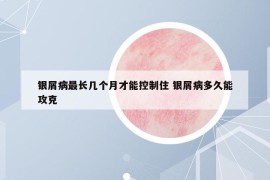銀屑病最長幾個月才能控制住 銀屑病多久能攻克