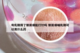 母乳期得了銀屑病能打針嗎 銀屑病哺乳期可以用什么藥