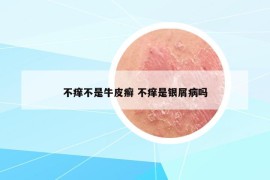 不癢不是牛皮癬 不癢是銀屑病嗎