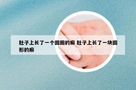 肚子上長了一個(gè)圓圈的癬 肚子上長了一塊圓形的癬