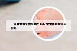 一歲寶寶得了銀屑病怎么辦 寶寶銀屑病能治愈嗎