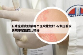 石家莊看皮膚病哪個(gè)醫(yī)院比較好 石家莊看皮膚病哪家醫(yī)院比較好