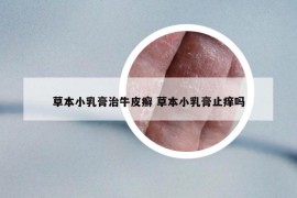 草本小乳膏治牛皮癬 草本小乳膏止癢嗎