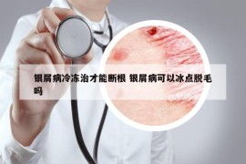 銀屑病冷凍治才能斷根 銀屑病可以冰點脫毛嗎