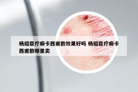 楊紹臣療癬卡西甫散效果好嗎 楊紹臣療癬卡西甫散哪里賣(mài)