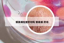 銀屑病檢查肝對嗎 銀屑病 肝功