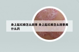 身上起紅癬怎么回事 身上起紅癬怎么回事用什么藥