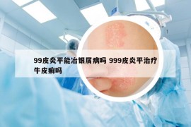 99皮炎平能冶銀屑病嗎 999皮炎平治療牛皮癬嗎