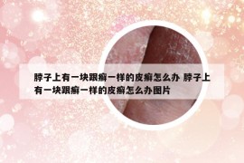 脖子上有一塊跟癬一樣的皮癬怎么辦 脖子上有一塊跟癬一樣的皮癬怎么辦圖片