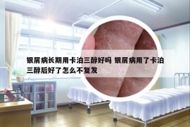 銀屑病長(zhǎng)期用卡泊三醇好嗎 銀屑病用了卡泊三醇后好了怎么不復(fù)發(fā)
