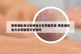 銀屑病能用注射用復(fù)方甘草酸苷是 銀屑病吃復(fù)方甘草酸苷片管用嗎