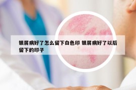 銀屑病好了怎么留下白色印 銀屑病好了以后留下的印子