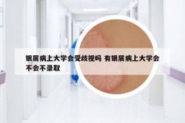 銀屑病上大學(xué)會受歧視嗎 有銀屑病上大學(xué)會不會不錄取
