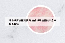 濟(jì)南銀屑病醫(yī)院薪資 濟(jì)南銀屑病醫(yī)院治療效果怎么樣