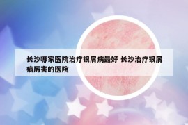 長(zhǎng)沙哪家醫(yī)院治療銀屑病最好 長(zhǎng)沙治療銀屑病厲害的醫(yī)院