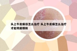 頭上牛皮癬該怎么治療 頭上牛皮癬怎么治療才能徹底根除