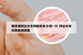 銀屑病阿達(dá)木生物制劑多少錢一針 阿達(dá)木單抗銀屑病用量