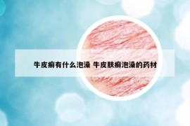 牛皮癬有什么泡澡 牛皮膚癬泡澡的藥材