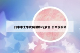 日本本土牛皮癬濕疹vg軟膏 日本皮癬藥