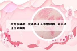 頭部銀屑病一直不消退 頭部銀屑病一直不消退什么原因