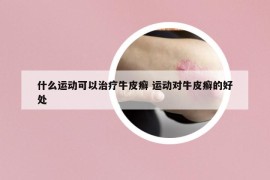 什么運(yùn)動可以治療牛皮癬 運(yùn)動對牛皮癬的好處